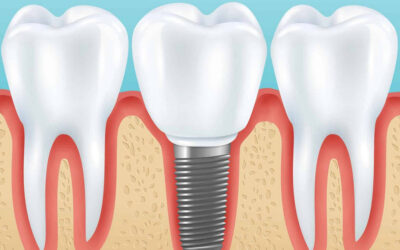 How Much Does a Dental Implant in Columbus Cost