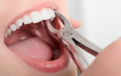 Is Tooth Extraction Painful? Dispelling the Myths